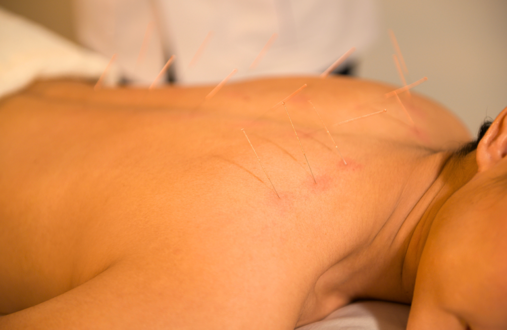 Patient receives acupuncture. Acupuncture. Brisbane Livewell Clinic