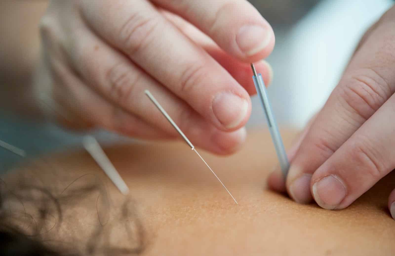 Acupuncture for Menopause and Perimenopause