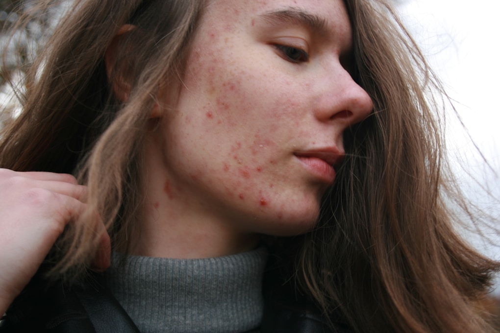 Teenager with Acne before seeing an Acne Naturopath