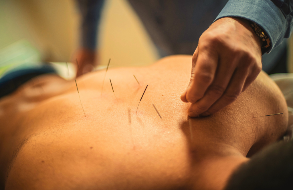 Acupuncture needles on man's back for back pain. Acupuncture Queensland. Brisbane Livewell Clinic