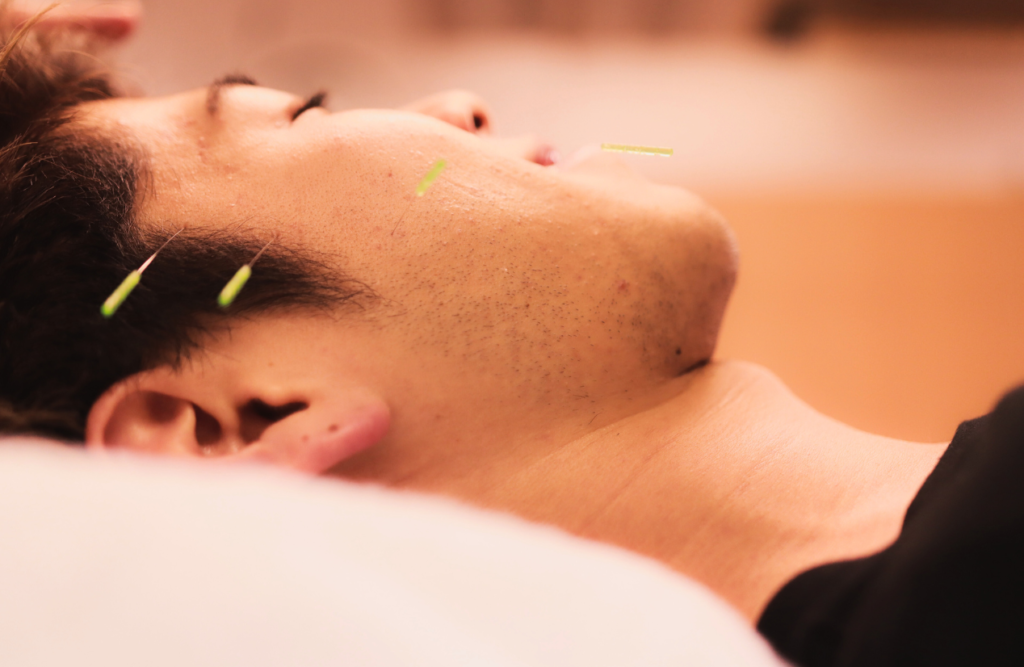 Man receiving cosmetic acupuncture. Acupuncture Queensland. Brisbane Livewell Clinic